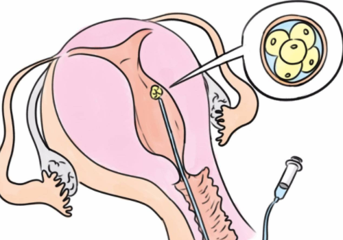 俄羅斯做試管費用？